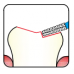 Osung Crown Posterior/ Occlusal Depth Orientation Flat Round (Taper) FG Shank 584-18F2 Fine Grit Diamond Bur 5/PK
